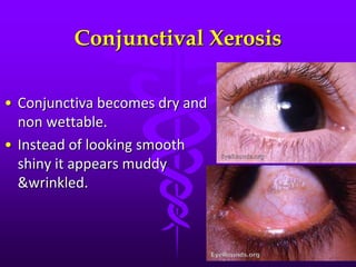 Conjunctival Xerosis
• Conjunctiva becomes dry and
non wettable.
• Instead of looking smooth
shiny it appears muddy
&wrinkled.
 