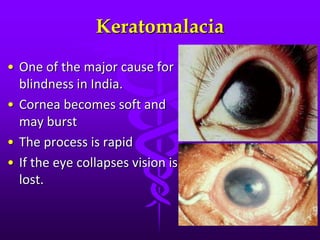 Keratomalacia
• One of the major cause for
blindness in India.
• Cornea becomes soft and
may burst
• The process is rapid
• If the eye collapses vision is
lost.
 