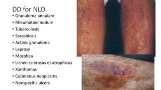 Ulcerative Dm Rash CUTANEOUS MANIFESTATIONS OF DM.pptx