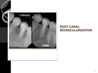 ROOT CANAL
REVASCULARIZATION
70
 