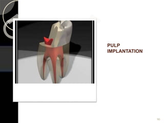 PULP
IMPLANTATION
90
 