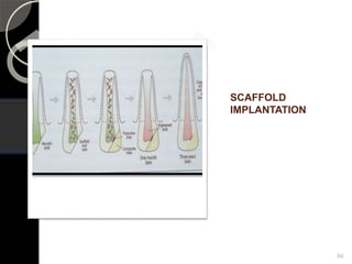 SCAFFOLD
IMPLANTATION
94
 