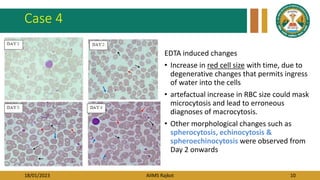 18/01/2023 AIIMS Rajkot 10
Case 4
EDTA induced changes
• Increase in red cell size with time, due to
degenerative changes that permits ingress
of water into the cells
• artefactual increase in RBC size could mask
microcytosis and lead to erroneous
diagnoses of macrocytosis.
• Other morphological changes such as
spherocytosis, echinocytosis &
spheroechinocytosis were observed from
Day 2 onwards
 