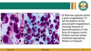 18/01/2023 AIIMS Rajkot 35
• D) Marrow aspirate shows
a giant megaloblast {*)
(at the bottom of the
picture)with megaloblasts
showing features of
dyserythropoiesis in the
form of irregular nuclei .
E) Bone marrow shows
erythroid hyperplasia.
Mitosis is frequent .
 