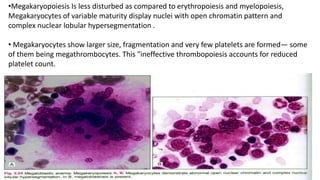 •Megakaryopoiesis Is less disturbed as compared to erythropoiesis and myelopoiesis,
Megakaryocytes of variable maturity display nuclei with open chromatin pattern and
complex nuclear lobular hypersegmentation .
• Megakaryocytes show larger size, fragmentation and very few platelets are formed— some
of them being megathrombocytes. This "ineffective thrombopoiesis accounts for reduced
platelet count.
 