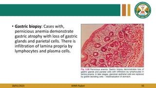 18/01/2023 AIIMS Rajkot 55
• Gastric biopsy: Cases with,
pernicious anemia demonstrate
gastric atrophy with loss of gastric
glands and parietal cells. There is
infiltration of lamina propria by
lymphocytes and plasma cells.
 