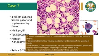 18/01/2023 AIIMS Rajkot 65
Case 7
• 4 month old child
Severe pallor and
supernumerary
thumb
• Hb 5 gm/dl
• TLC 5600/cmm
• Platelet
2,15,000/cmm
• Retic < 0.2%
Congenital red cell hypoplasia or Diamond-Blackfan anemia is a pure RBC aplasia in
children.
Congenital abnormalities, including short stature and skeletal defects, specially of
thumbs
 The diagnosis of DBA is suggested by a macrocytic (although sometimes normocytic)
anemia with reticulocytopenia presenting in the first 6 months of life.
Bone marrow examination reveals decreased erythroid precursors.
 