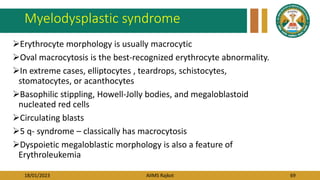 18/01/2023 AIIMS Rajkot 69
Myelodysplastic syndrome
Erythrocyte morphology is usually macrocytic
Oval macrocytosis is the best-recognized erythrocyte abnormality.
In extreme cases, elliptocytes , teardrops, schistocytes,
stomatocytes, or acanthocytes
Basophilic stippling, Howell-Jolly bodies, and megaloblastoid
nucleated red cells
Circulating blasts
5 q- syndrome – classically has macrocytosis
Dyspoietic megaloblastic morphology is also a feature of
Erythroleukemia
 