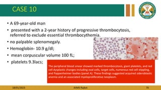 18/01/2023 AIIMS Rajkot 70
CASE 10
• A 69-year-old man
• presented with a 2-year history of progressive thrombocytosis,
referred to exclude essential thrombocythemia.
• no palpable splenomegaly.
• Hemoglobin- 10.9 g/dl;
• mean corpuscular volume 100 fL;
• platelets 9.3lacs;
The peripheral blood smear showed marked thrombocytosis, giant platelets, and red
cell dysplastic changes including oval cells, target cells, numerous red cell stippling,
and Pappenheimer bodies (panel A). These findings suggested acquired sideroblastic
anemia and an associated myeloproliferative neoplasm.
 
