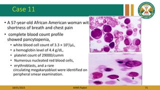 18/01/2023 AIIMS Rajkot 71
Case 11
• A 57-year-old African American woman with
shortness of breath and chest pain
• complete blood count profile
showed pancytopenia,
• white blood cell count of 3.3 × 103/μL,
• a hemoglobin level of 4.4 g/dL,
• platelet count of 29000/cumm
• Numerous nucleated red blood cells,
• erythroblasts, and a rare
circulating megakaryoblast were identified on
peripheral smear examination.
 