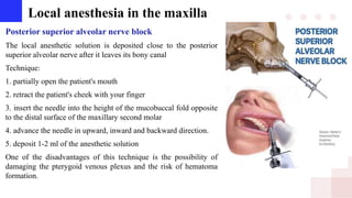 Local anesthesia in the maxilla
Posterior superior alveolar nerve block
The local anesthetic solution is deposited close to the posterior
superior alveolar nerve after it leaves its bony canal
Technique:
1. partially open the patient's mouth
2. retract the patient's cheek with your finger
3. insert the needle into the height of the mucobuccal fold opposite
to the distal surface of the maxillary second molar
4. advance the needle in upward, inward and backward direction.
5. deposit 1-2 ml of the anesthetic solution
One of the disadvantages of this technique is the possibility of
damaging the pterygoid venous plexus and the risk of hematoma
formation.
 