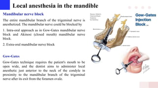 Local anesthesia in the mandible
Mandibular nerve block
The entire mandibular branch of the trigeminal nerve is
anesthetized. The mandibular nerve could be blocked by
1. Intra-oral approach as in Gow-Gates mandibular nerve
block and Akinosi (closed mouth) mandibular nerve
block.
2. Extra-oral mandibular nerve block
Gow-Gates
Gow-Gates technique requires the patient's mouth to be
open wide, and the dentist aims to administer local
anesthetic just anterior to the neck of the condyle in
proximity to the mandibular branch of the trigeminal
nerve after its exit from the foramen ovale.
 