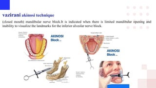 vazirani akinosi technique
(closed mouth) mandibular nerve block.It is indicated when there is limited mandibular opening and
inability to visualize the landmarks for the inferior alveolar nerve block.
 
