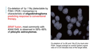 Co-deletion of 1p / 19q (detectable by
FISH / PCR / microarray) is
characteristic of oligodendroglioma
predicting response to conventional
therapy.
BRAF fusion, most commonly with
KIAA1549, is observed in 59%–90%
of pilocytic astrocytomas.
Co-deletion of 1p (B) and 19q (C) by dual color
FISH. Target (orange) to control (green) signal
ratio of ≤ 0.8 indicates loss of the target allele.
 