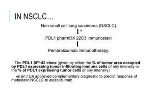 IN NSCLC…
Non small cell lung carcinoma (NSCLC)
PDL1 pharmDX 22C3 immunostain
Pembrolizumab immunotherapy.
The PDL1 SP142 clone (given by either the % of tumor area occupied
by PDL1 expressing tumor infiltrating immune cells of any intensity or
the % of PDL1 expressing tumor cells of any intensity)
-is an FDA approved complementary diagnostic to predict response of
metastatic NSCLC to atezolizumab.
+
 