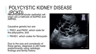 POLYCYSTIC KIDNEY DISEASE
(PCKD)
Renal cysts of tubular epithelial cell
origin are a hallmark of ADPKD and
ARPKD.
Causative genetic loci are:
 PKD1 and PKD2, which code for
the polycystins, and
 PKHD1, which codes for fibrocystin
Due to the size and complexity of
these genes, diagnosis is still made
predominantly using radiologic
findings and family history.
 