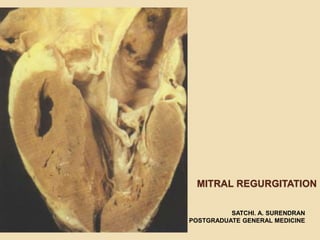 MITRAL REGURGITATION
SATCHI. A. SURENDRAN
POSTGRADUATE GENERAL MEDICINE
 