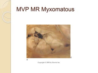 MVP MR Myxomatous
 