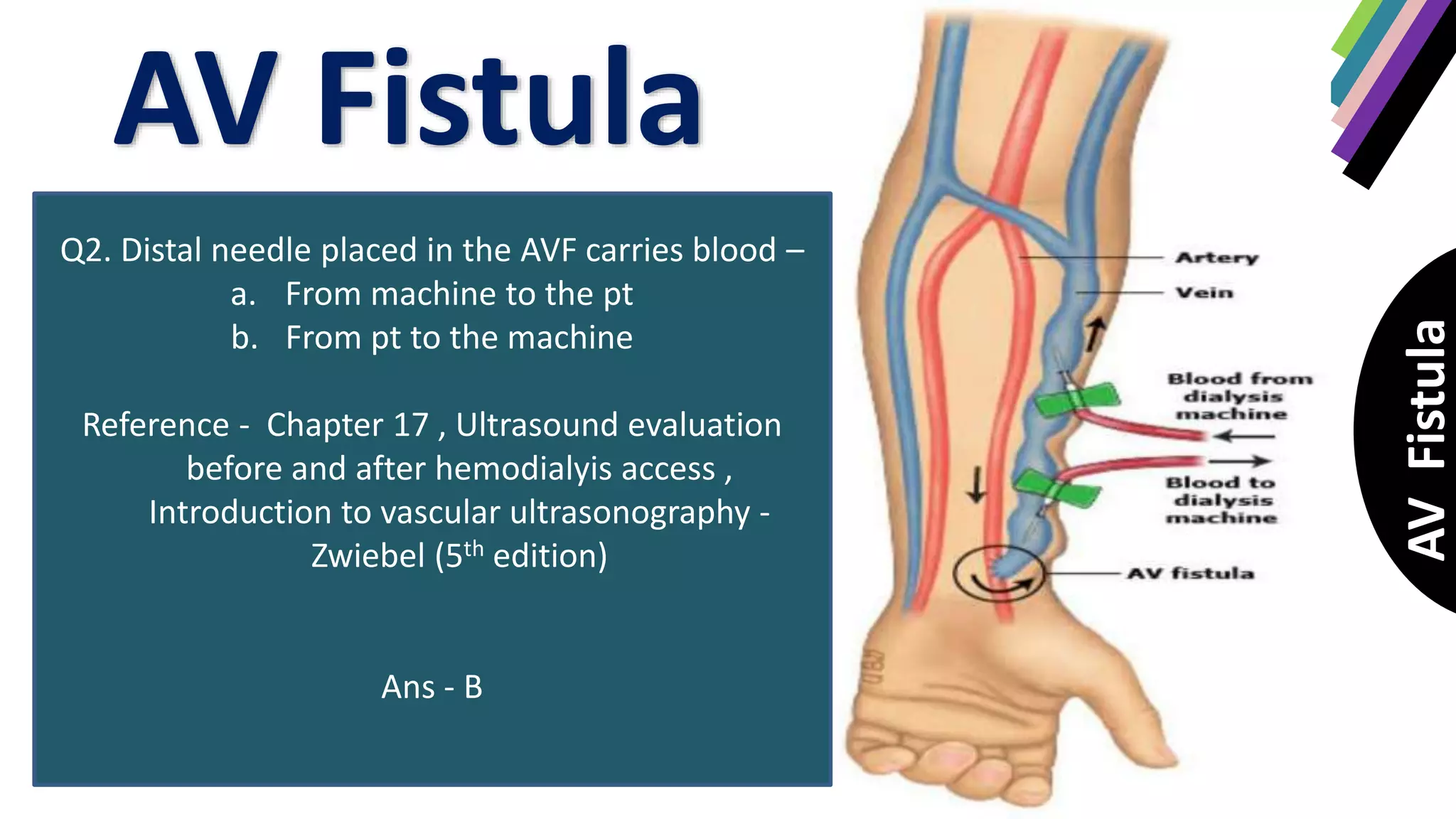 Role of USG in A-V fistula assessment | PPTX