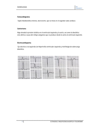 SEMIOLOGIA VII
CICLO2011
7 ESTENOSIS E INSUFICIENCIA AORTICA Y PULMONAR
Fonocardiograma:
Soplo holodiastólico intenso, decreciente, que se inicia en el segundo ruido cardiaco.
Cateterismo:
Algo elevada la presión sistólica en el ventrículo izquierdo y la aorta, así como la diastólica;
esta última a causa del reflujo sanguíneo que se produce desde la aorta al ventrículo izquierdo.
Electrocardiograma.
Eje eléctrico a la izquierda con hipertrofia ventricular izquierda y morfología de sobrecarga
diastólica.
 