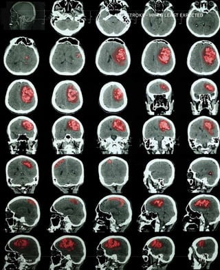 sch.gov.qa 33
STROKE - WHEN LEAST EXPECTED
33sch.gov.qa
 