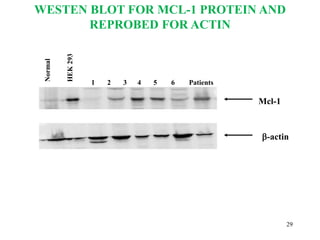 Normal
HEK
293
1 2 3 4 5 6 Patients
Mcl-1
b-actin
WESTEN BLOT FOR MCL-1 PROTEIN AND
REPROBED FOR ACTIN
29
 