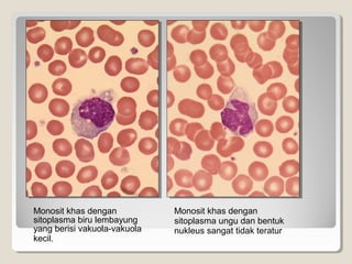 Monosit khas dengan
sitoplasma biru lembayung
yang berisi vakuola-vakuola
kecil.
Monosit khas dengan
sitoplasma ungu dan bentuk
nukleus sangat tidak teratur
 
