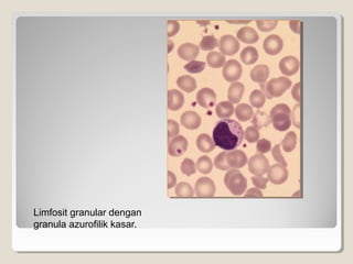 Limfosit granular dengan
granula azurofilik kasar.
 
