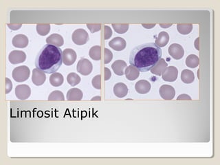 Limfosit Atipik
 