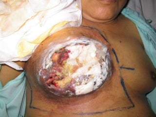 5676135 kanker-payudara