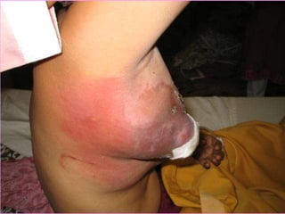 5676135 kanker-payudara