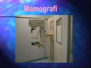 5676135 kanker-payudara