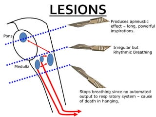Pons
Medulla
Produces apneustic
effect – long, powerful
inspirations.
Stops breathing since no automated
output to respiratory system – cause
of death in hanging.
LESIONS
Irregular but
Rhythmic Breathing
 