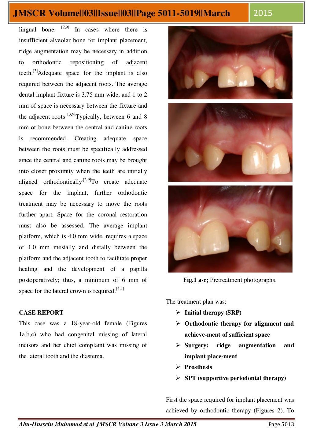 Management of Congenitally Missing Lateral Incisors with Orthodontics…