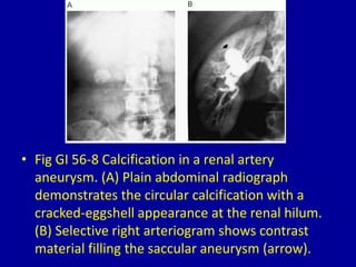 • Fig GI 56-8 Calcification in a renal artery
aneurysm. (A) Plain abdominal radiograph
demonstrates the circular calcification with a
cracked-eggshell appearance at the renal hilum.
(B) Selective right arteriogram shows contrast
material filling the saccular aneurysm (arrow).