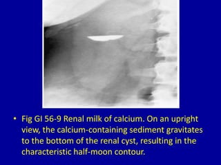 • Fig GI 56-9 Renal milk of calcium. On an upright
view, the calcium-containing sediment gravitates
to the bottom of the renal cyst, resulting in the
characteristic half-moon contour.