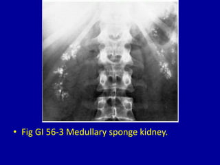 • Fig GI 56-3 Medullary sponge kidney.