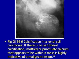 • Fig GI 56-6 Calcification in a renal cell
carcinoma. If there is no peripheral
calcification, mottled or punctuate calcium
that appears to be within a mass is highly
indicative of a malignant lesion.72