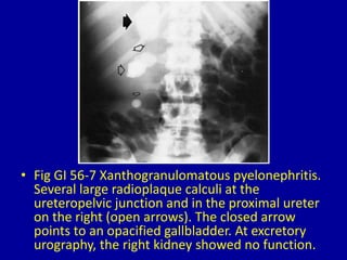 • Fig GI 56-7 Xanthogranulomatous pyelonephritis.
Several large radioplaque calculi at the
ureteropelvic junction and in the proximal ureter
on the right (open arrows). The closed arrow
points to an opacified gallbladder. At excretory
urography, the right kidney showed no function.