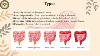 Protitis Colitis Comprehensive Overview of Inflammatory Bowel Diseases: Crohn's and ...