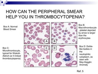 HOW CAN THE PERIPHERAL SMEAR
HELP YOU IN THROMBOCYTOPENIA?
Box A: Normal
Blood Smear
Box B:
Macrothrombocyte
, platelet depicted
by arrow is larger
than the
erythrocytes
Box C:
Microthrombocyte,
typical for Wiskott-
Aldrich (or X linked
thrombocytopenia)
Box D: Dohle-
like bodies in
the
neutrophilic
cytoplasm, as
seen with
May-Hegglin
Anomaly
Ref. 5
 