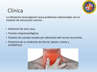Clínica
La afectación locorregional causa problemas relacionados con la
invasión de estructuras vecinas :
• Síndrome de vena cava,
• Fistulas traqueoesofagicas,
• Paralisis de cuerdas vocales por afectación del nervio recurrente,
• Presencia de un síndrome de Horner (ptosis, miosis y
enoftalmos)
 