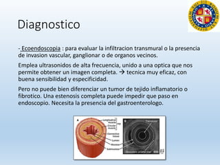 Diagnostico
- Ecoendoscopia : para evaluar la infiltracion transmural o la presencia
de invasion vascular, ganglionar o de organos vecinos.
Emplea ultrasonidos de alta frecuencia, unido a una optica que nos
permite obtener un imagen completa.  tecnica muy eficaz, con
buena sensibilidad y especificidad.
Pero no puede bien diferenciar un tumor de tejido inflamatorio o
fibrotico. Una estenosis completa puede impedir que paso en
endoscopio. Necesita la presencia del gastroenterologo.
 