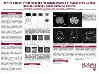 In vivo sodium (23Na) magnetic resonance imaging of human knee using a
pseudo-random k-space sampling scheme
Alireza Akbari1, Konrad Anand2, Christopher Anand3,4, and Michael D. Noseworthy1,4
3-dimensional center-out k-space sampling
schemes are at the heart of in vivo sodium
(23Na) magnetic resonance imaging (MRI).
These sampling methods offer ultra-short
echo times making them ideal for short T2
species such as 23Na. Some schemes, such as
spectrally weighted twisted projection
imaging (TPI)[1], require fewer number of
projections in order to fulﬁll the Nyquist
sampling criterion thus leading to shorter
scan times. In order to lessen scan time, the
number of projections can even be reduced
further (i.e. undersampling) at the cost of
inducing aliasing artifacts. However,
coherent aliasing can be minimized if
undersampling is done randomly as it leads
to incoherent summation of the aliasing
artifacts. This was the basis of the DURGA
sequence using in proton imaging [2]. In this
work, we demonstrate the feasibility of
pseudo-random k-space sampling (ﬁg.1d) for
in vivo 23Na MRI that allows shorter scan
times.
The effects of aliasing using fully-sampled,
regularly-, and randomly-under-sampled
Cartesian, and pseudo-random non-Cartesian
schemes were simulated. A resolution
phantom (Model ECT/DLX/MP, Data
Spectrum Corp., Durham, North Carolina)
immersed in 6% saline and doped with 2.9 g/
L copper sulfate was used to measure the
actual achievable resolution when applying
pseudo-random sampling. In vivo knee 23Na
MR images of two subjects were
subsequently obtained. All imaging was
done using a GE MR750 3T (General Electric
Healthcare, Milwaukee WI) and an in-house-
made 12-pole quadrature transmit/receive
sodium birdcage coil. The pulse sequence
consisted of a single 500!s hard pulse, TE/
TR = 0.46/75 ms, ﬂip angle = 90°, NEX= 64,
400 trajectories, 2000 samples per trajectory,
sampling rate of 4!s/sample, leading to a
total scan time of 32 minutes.
a	
The effects of under-sampling using the two
sampling schemes are shown (ﬁg.2). Figure 3
shows the actual achievable resolution using
the proposed sampling scheme. Figure 4
demonstrates the in vivo sodium knee MR
images acquired using the pseudo-random
sampling scheme. The SNR in patellar,
femoro-tibial, and posterior condyle cartilage
was measured as 10.6±1.1, 10.5±2.0, 9.6 ± 1.2
(mean ± SE), respectively.
Figure 1. K-space acquisition schemes used to investigate
how different under-sampling patterns produce image aliasing
artifacts. 3-dimensional views of a) fully sampled, b) regularly,
and c) randomly under-sampled Cartesian, and d) pseudo-
randomly under-sampled non-Cartesian schemes along with
their 2-dimensional views through the ky-kz plane (e-h),
respectively, are depicted. For better visualization, only a
subset of randomly under-sampled non-Cartesian trajectories
is shown in the 3D view.
Figure 2. A 2D representation through the zy-plane of point
spread function (PSF) simulations of: a) fully sampled; b)
regularly under-sampled; c) randomly under-sampled
Cartesian; and d) randomly under-sampled non-Cartesian k-
space sampling. The 1D PSF representation through the y-
direction are shown in (e-h), respectively. The reconstructed
images sampled from the simulated phantom using the k-
space sampling schemes (top), respectively, are shown (i-l).
Figure 4. In vivo axial, coronal, and sagittal views of 23Na MRI of a healthy subject obtained by the
pseudo-random non-Cartesian k-space acquisition.
The results indicate that pseudo-random non-
Cartesian sampling remarkably reduces the
aliasing artifacts caused by undersampling.
The in vivo results conﬁrm the feasibility of
this scheme for 23Na MRI. This scheme will
help reduce the total scan time through a
high sampling-duty cycle with fewer
trajectories, while keeping aliasing artifacts
minimal due to the randomness of the
sampling scheme.
[1] Boada FE, et al. Magn Reson Med. 1997;38(6):1022–8. [2] Curtis
AT, Anand CK. Int J Biomed Imaging. 2008;2008.
akbaria@mcmaster.ca
Introduction
Methods
Results Conclusion
More Information
References
F i g u r e 3 . M R I r e s o l u t i o n
measurement. Axial proton (a)
and corresponding sodium (b)
images of a resolution phantom
with rods of 1.2, 1.6, 2.4, 3.2, 4.0,
and 4.8 mm in diameter. The
actual resolution achieved by
randomly sampled non-Cartesian
acquisition was 4.0 mm.
 