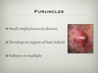 o Small staphylococcal abscess
o Develops in region of hair follicle
o Solitary or multiple
Furuncles
 