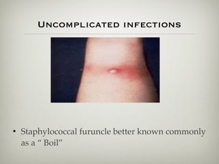 Uncomplicated infections
• Staphylococcal furuncle better known commonly
as a “ Boil”
 