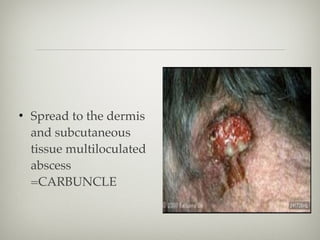• Spread to the dermis
and subcutaneous
tissue multiloculated
abscess
=CARBUNCLE
 