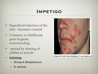 Impetigo
• Superﬁcial infection of the
skin - becomes crusted
• Common in childhood,
poor hygiene,
overcrowding
• spread by sharing of
clothes or towels
• Aetiology
• Group A Streptococci
• S. aureus
 