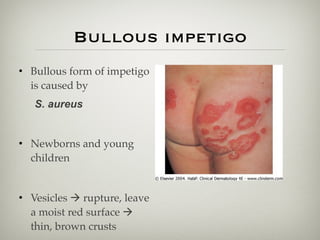 Bullous impetigo
• Bullous form of impetigo
is caused by
S. aureus
• Newborns and young
children
• Vesicles ! rupture, leave
a moist red surface !
thin, brown crusts
 