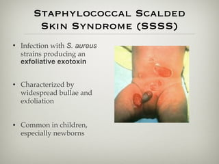 Staphylococcal Scalded
Skin Syndrome (SSSS)
• Infection with S. aureus
strains producing an
exfoliative exotoxin
• Characterized by
widespread bullae and
exfoliation
• Common in children,
especially newborns
 